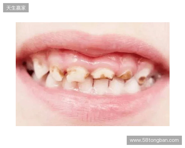 韦林顿确诊上唇部贯通伤;11、21牙半脱位;上颌前牙区牙槽骨骨折 韦林顿确诊上唇部贯通伤;11、21牙半脱位;上颌前牙区牙槽骨骨折